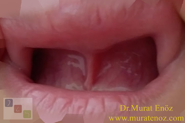 Alveoler hipoplaziye neden olan üst dudak bağı - Üst dudak bağına bağlı üst çene kemiğinde yapısal etkilenme - Üst dudak bağının zararları