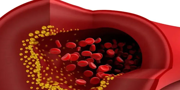 How To Clean Your Arteries With One Simple Fruit