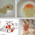 Cara mudah menyembuhkan hematospermia dengan antibiotik