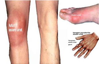 Gula asam urat kolesterol normal, mengatasi asam urat pada tangan, obat farmakologi untuk asam urat, asam urat normal kolestrol, asam urat pantang makanan apa, tips cara menyembuhkan penyakit asam urat, obat asam urat di warung, obat asam urat tradisional mujarab, kadar asam urat tidak normal, obt asam urat generik, bolehkah penderita asam urat makan cincau