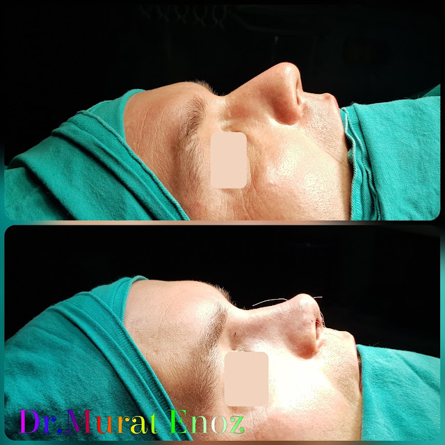 Twisted Nose Aesthetic,Rhinoplasty in Men Istanbul,Crooked Nose Aesthetic Surgery in Istanbul, Crooked Nose Job in Male Patient, Male Nose Aesthetic Surgery,Men's Rhinoplasty in Istanbul,Nose Job Surgery For Men in Istanbul,Male Nose Operation in Turkey,