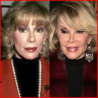 before and after joan rivers