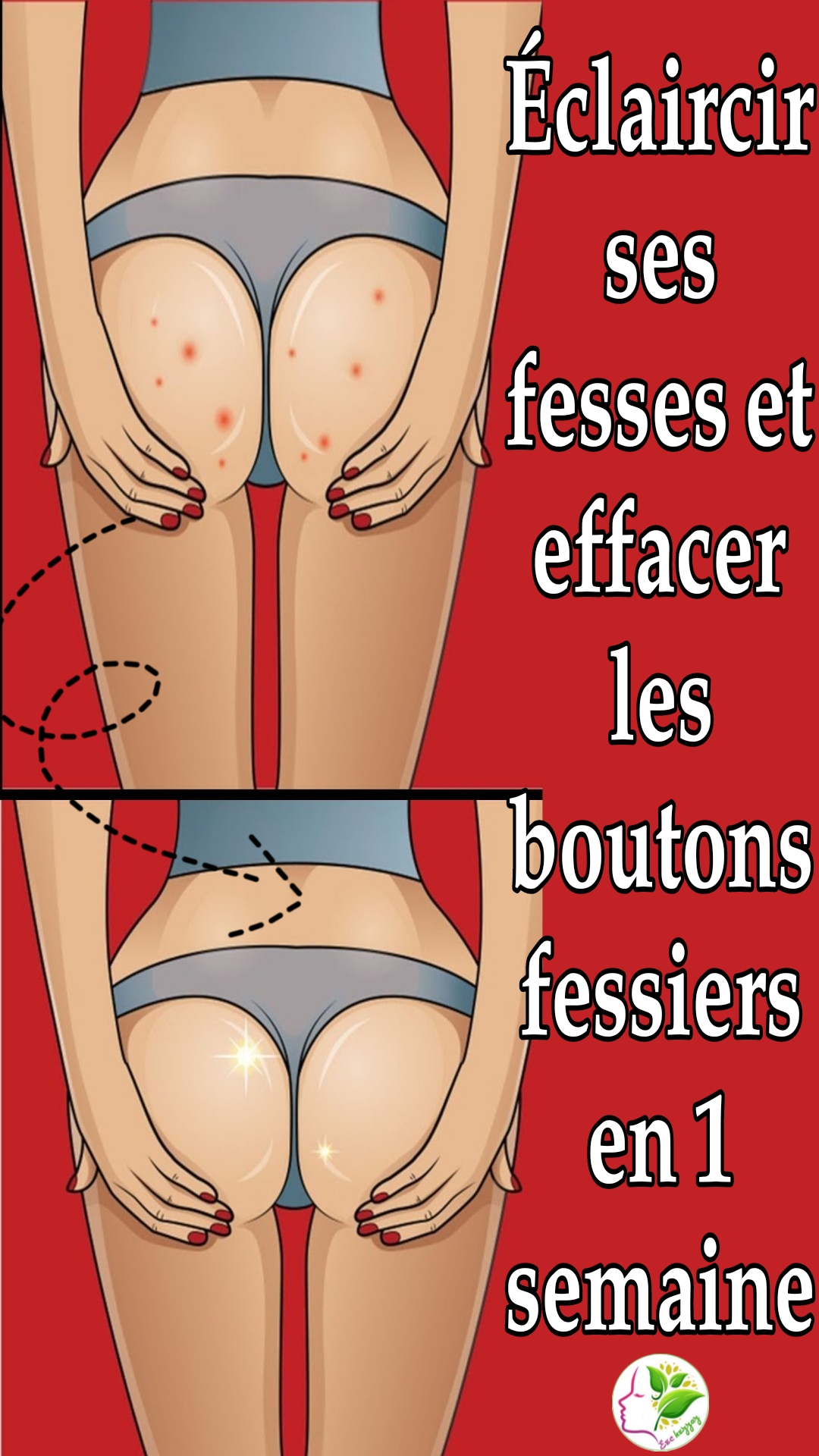 Éclaircir ses fesses et effacer les boutons fessiers en 1 semaine