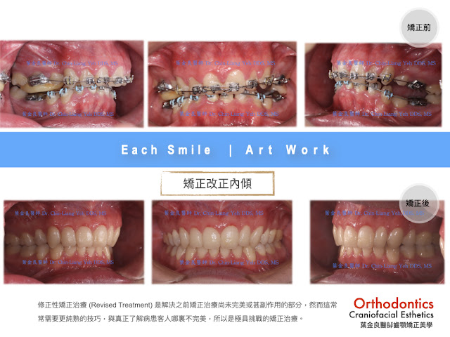 矯正後牙齒內傾？齒顎矯正專科挽救副作用