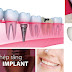 Những điều bạn cần biết về cấy răng Implant