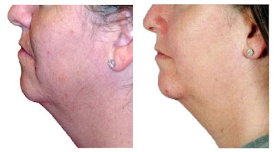 Microdermabrasion Pictures