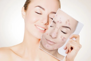 Home Remedies To Remove Pimple