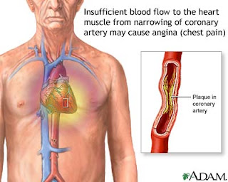 Angina pectoris