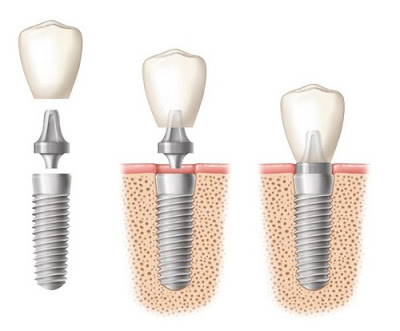 Khi nào nên cấy ghép Implant?