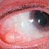 Conjunctival Cyst - Symptoms, Causes, Removal