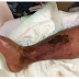 Pernas de um paciente afetadas por fasciíte necrosante