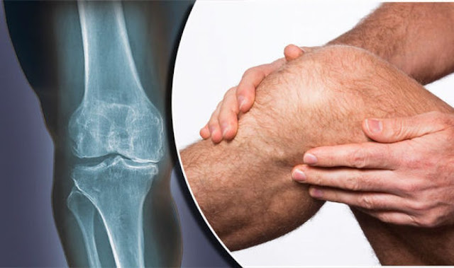 osteoarthritis pain relief