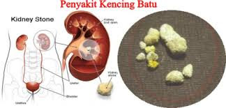 Penyebab, Gejala Dan Obat Herbal Kencing Batu Terampuh