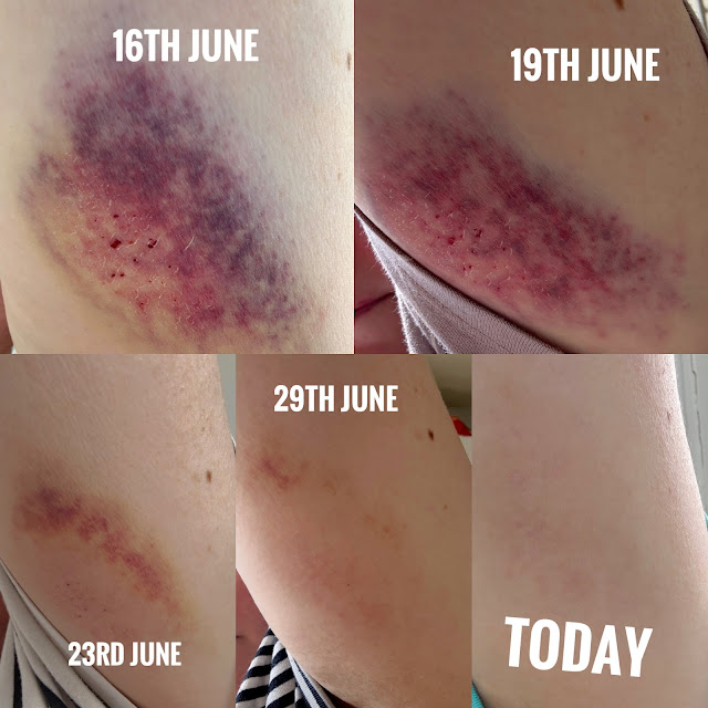 Healing Bruises & Supporting Skin Recovery with SBC Skincare’s Arnica Gel & Prolagel