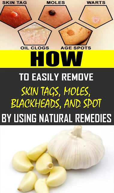 How To Easily Remove Skin Tags, Moles, Blackheads, Spots And Warts By Using Natural Remedies