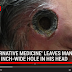 Shocking photos show how Alternative Medicine left inch-wide hole in man's head 