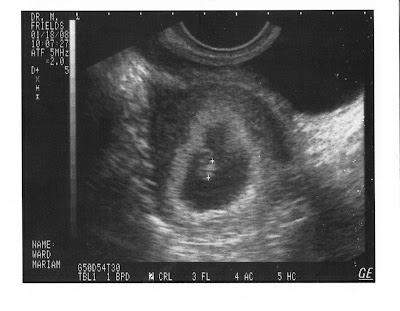 12 5 week ultrasound. Ultrasound pic 12 Weeks (looks