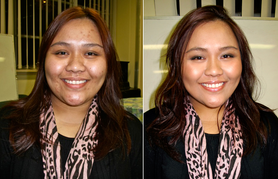 Before And After Microdermabrasion Pictures. I will put up my efore