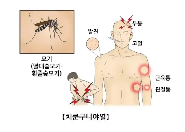 치쿤구니야 증상 그림