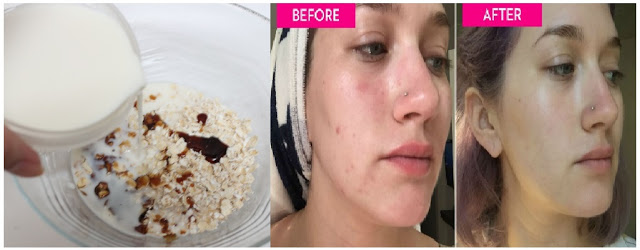 LUAR BIASA !!! Masker Ini Ampuh Basmi Jerawat di Wajah Dalam Kurun Waktu Yang Sangat Singkat !