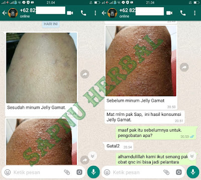 Cara Mengatasi Keringat Buntet / Biang Keringat