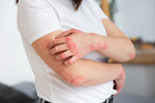 Scabies Resurgence: Navigating the Increase Amidst Other Concerns