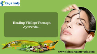 https://skincareayurveda.com/ayurveda-vitiligo-treatments-india/