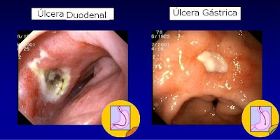 Úlcera duodenal e úlcera gástrica