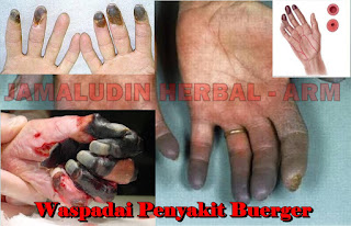 http://tilupuluhherbal.blogspot.co.id/2018/03/obat-herbal-untuk-mengobati-penyakit.html