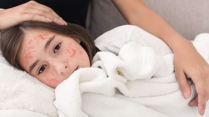 8 Measles Taboos for Children to Avoid