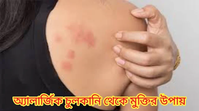 অ্যালার্জিক চুলকানি দূর করার কার্যকরী কৌশল - Effective strategies to relieve allergic itching