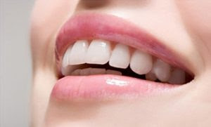 Phương pháp niềng răng khấp khểnh mất bao lâu?