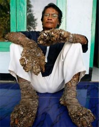 Medical Mysteries - Dede Kosawa: The Tree Man Searching for The Cure