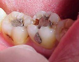Cara Menghilangkan Sakit Gigi