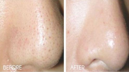 How To Quickly Get Rid Of Large Pores On Face and have perfect skin!
