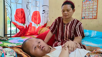 15 Tahun Hanya Terbaring, Remaja di Desa Galang Sui Pinyuh Alami Hidrosefalus
