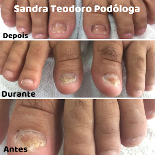 Tratamento para unhas encravadas em Itapema