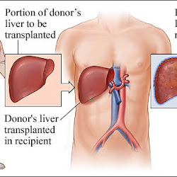 Liver Transplant