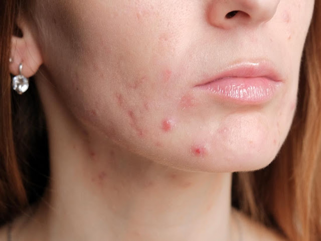 Pregnancy Acne, Natural Options for Treatment