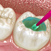 Cách chữa răng bị mẻ cực hiệu quả chỉ 1 lần thực hiện