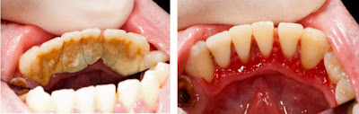 Tìm hiểu về bệnh mòn cổ răng