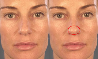 Bulbous nose Pictures, Definition, rhinoplasty, Contouring, Reduction