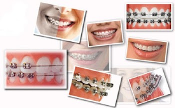 Niềng răng mọc lệch có hiệu quả không?
