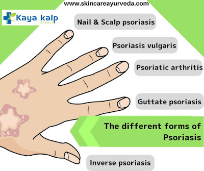 Ayurvedic Psoriasis Treatment by Kayakalp Global