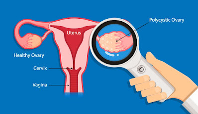 Can pregnancy occur with polycystic (pcos) ovary هل يحدث حمل مع تكيس المبايض