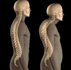 Osteoporosis in men
