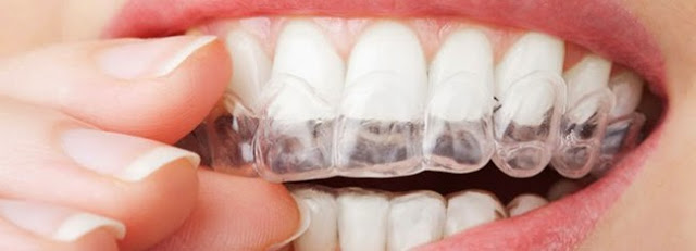 Tudo que você precisa saber antes de fazer um clareamento dental