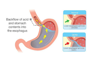 OBAT GERD PALING AMPUH RESEP DOKTER