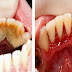 Wow ... Amazing !!! Turns Simple Banget Knocked Coral Dental, Dental As You Go White Pearl, the following steps were.