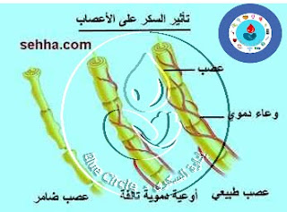 إعتلال الاعصاب Neuropathy 